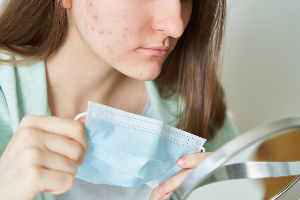 woman with acne taking off medical mask